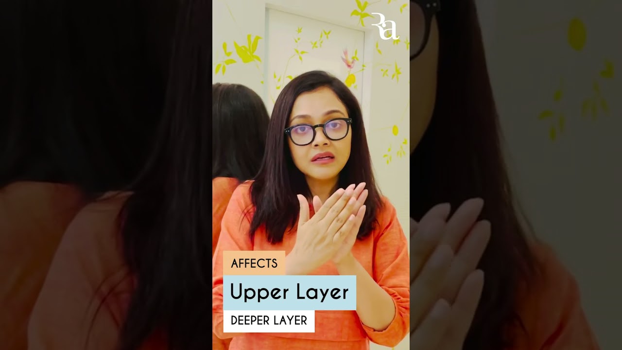 All About Melasma - The Pigmentation on the Cheek