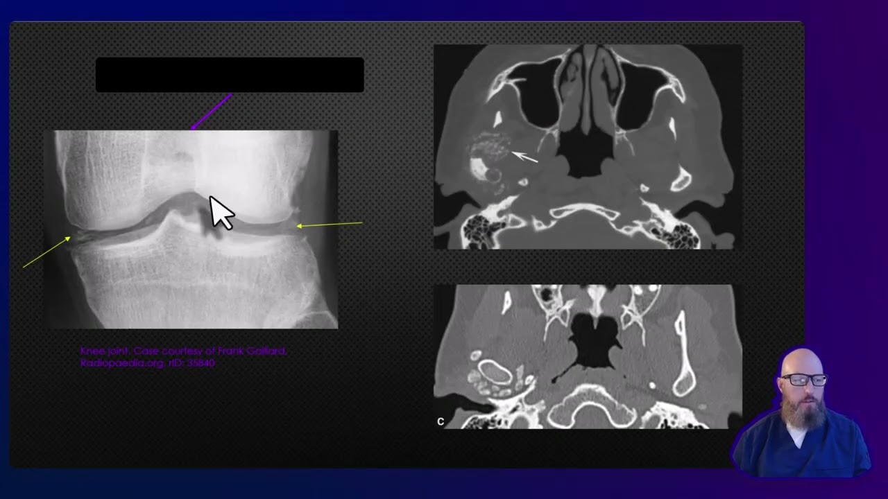 What Causes Calcifications in TMJ & Other Joints? Imaging & Differentials