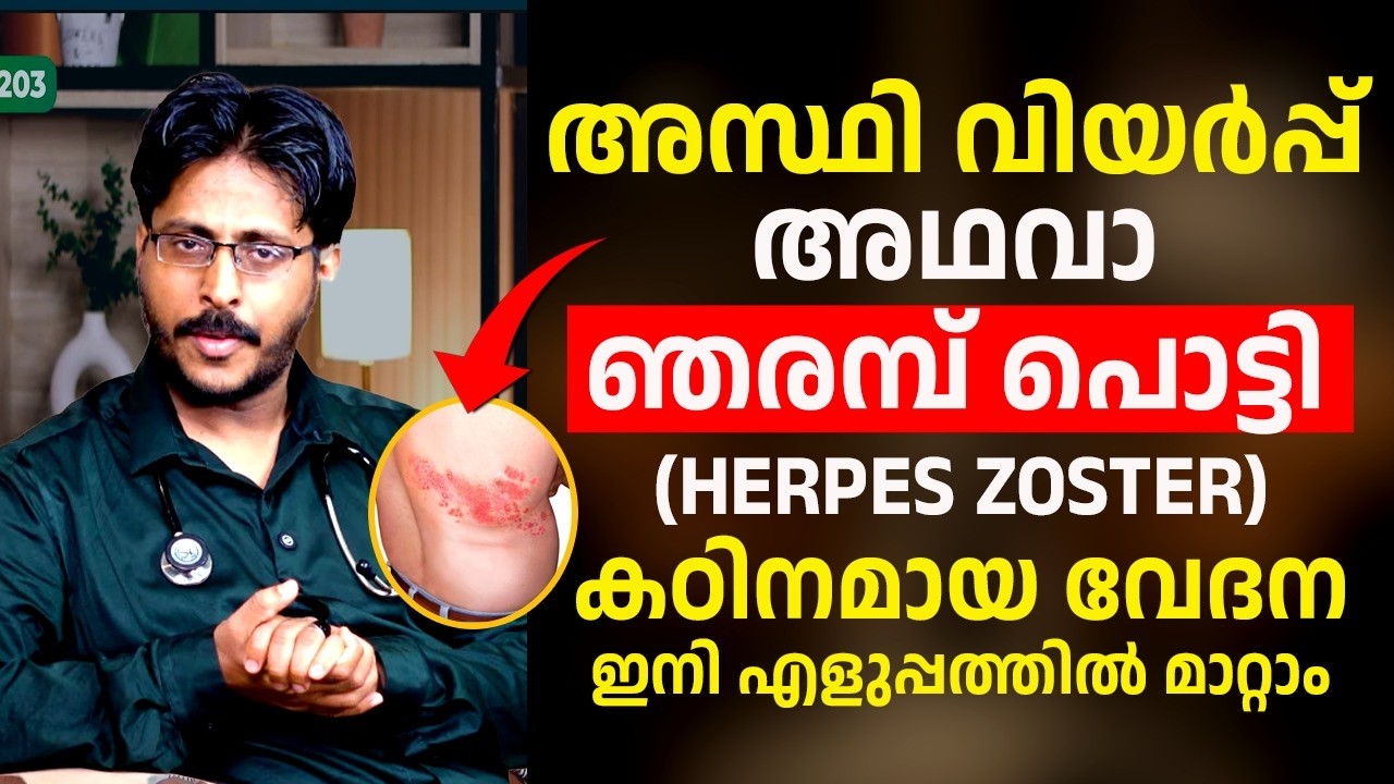 അസ്ഥി വിയർപ്പ്അഥവാഞരമ്പ് പൊട്ടി(HERPES ZOSTER)കഠിനമായ വേദന ഇനി എളുപ്പത്തിൽ മാറ്റാം Dr Aslam