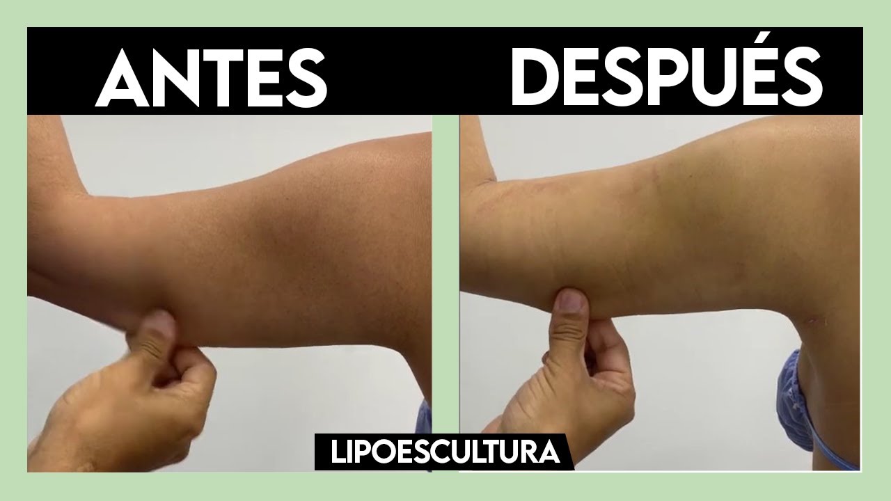 🍑 LIPOESCULTURA (Lipo) 360 Alta Definición + J PLASMA + Super BBL 🍑 ANTES y DESPUÉS ► Dr John Garcia