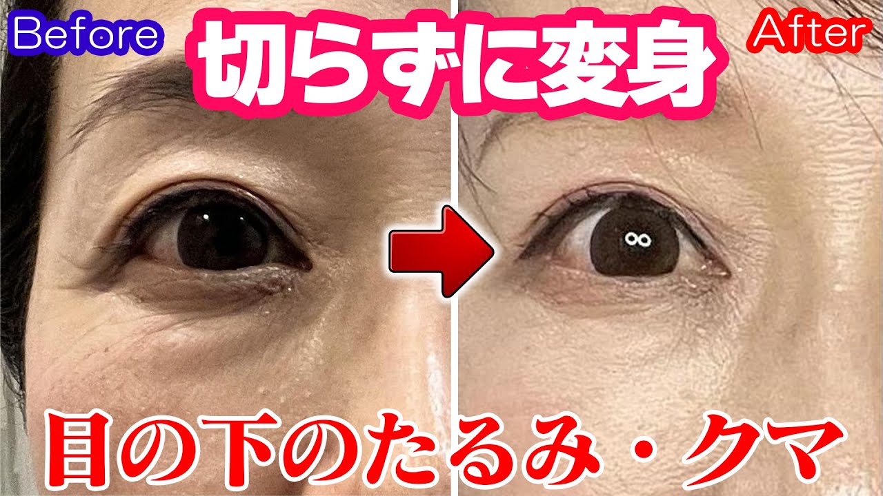 整形級!? 目の下のたるみ・クマ改善【自然に若見え】