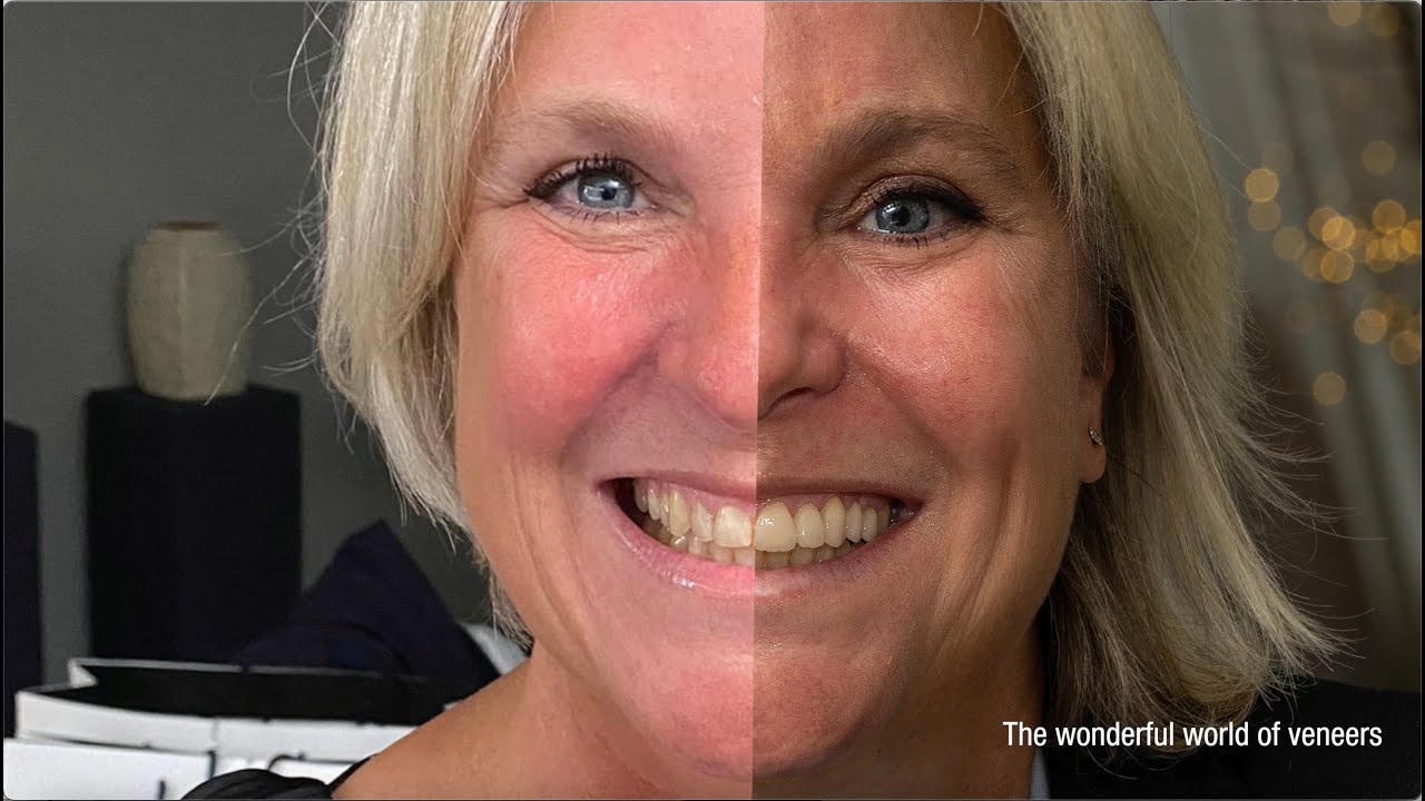 Visalys&reg; CemCore - Cosmetic Treatment (10 veneers)