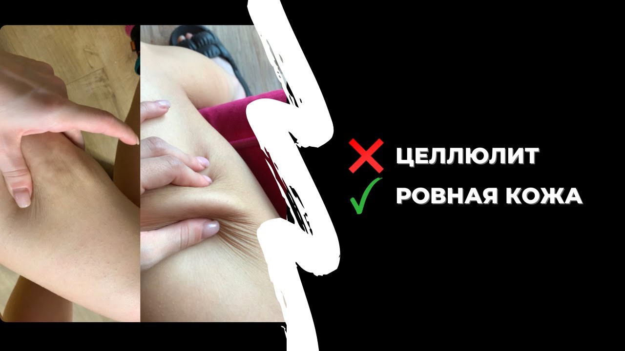 Как избавиться от целлюлита. Научно доказанный алгоритм борьбы с апельсиновой коркой