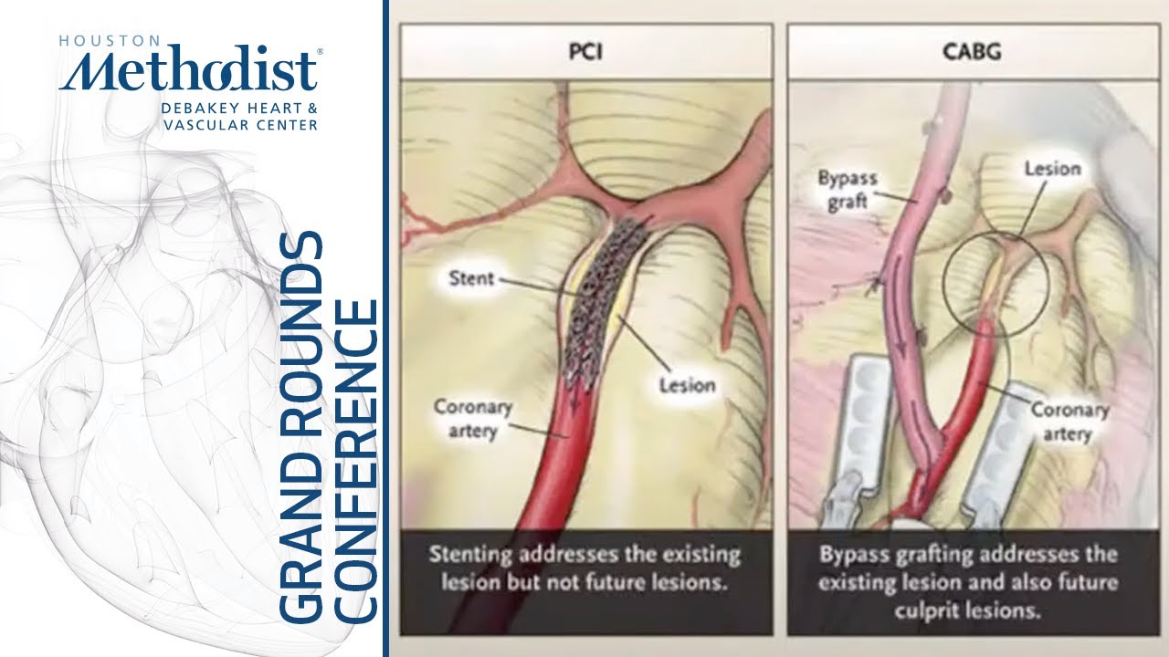 Revascularization for Multivessel Coronary Disease: PCI or CABG? (W. F. Fearon MD) November 18, 2021