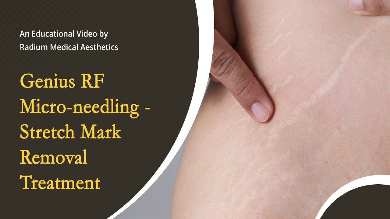 Removing Stretch Marks Effectively with Genius RF Microneedling