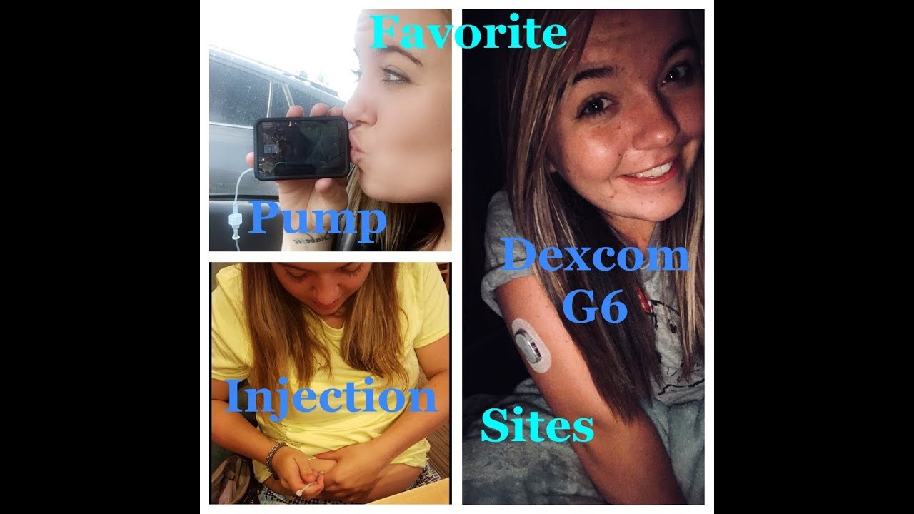 |FAVORITE DEXCOM G6 and TSLIM PUMP SITES| Daily Diabetics