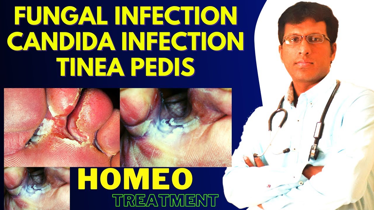 homeopathic medicine for fungal infection candida infection tinea pedis in hindi