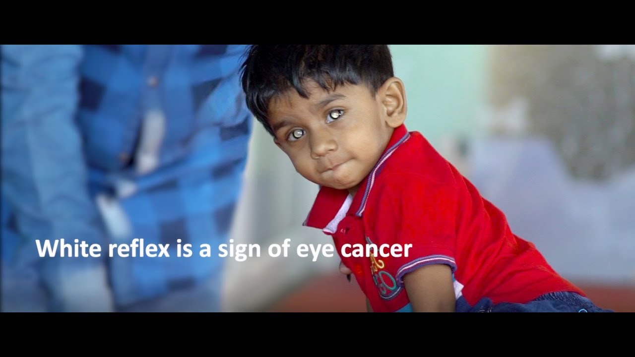 White reflex in child’s eye, a sign of eye cancer - support Whitathon 2019