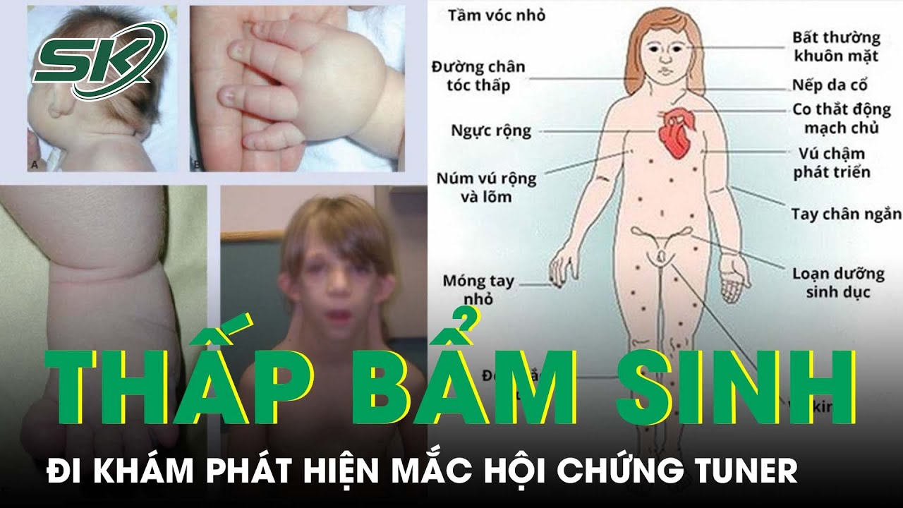 Thấp Hơn Bạn Cùng Trang Lứa, Đi Khám Phát Hiện Mắc Hội Chứng Turner I SKĐS
