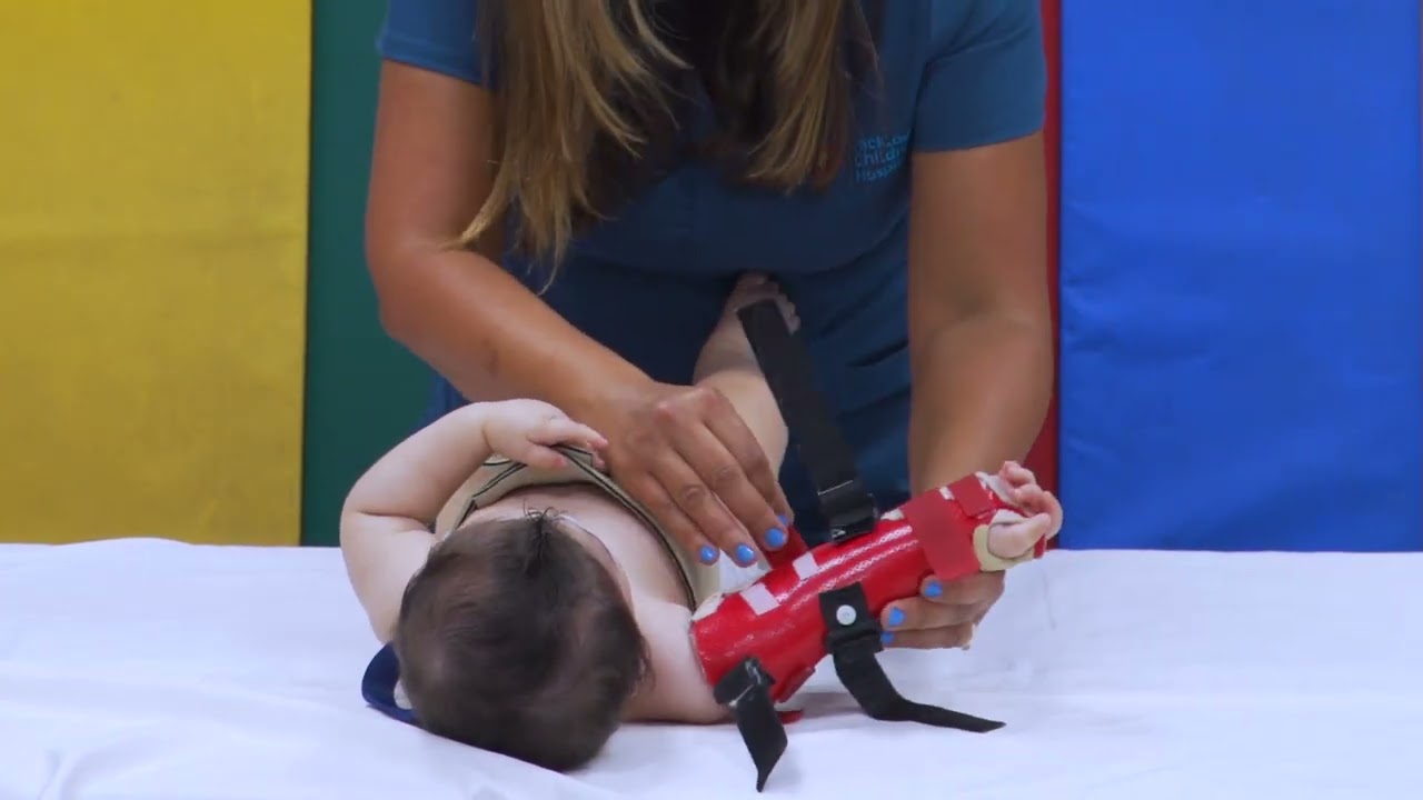 How to Apply a Circumferential Super Orthosis on Babies with a Brachial Plexus Injury