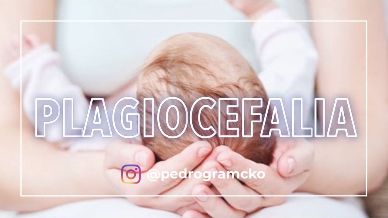 Plagiocefalia | todo lo que debes saber 
