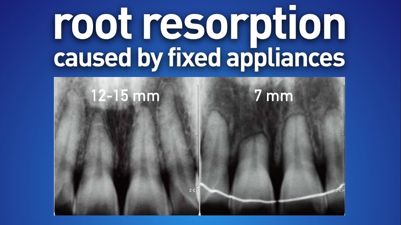 Root resorption caused by fixed appliances
