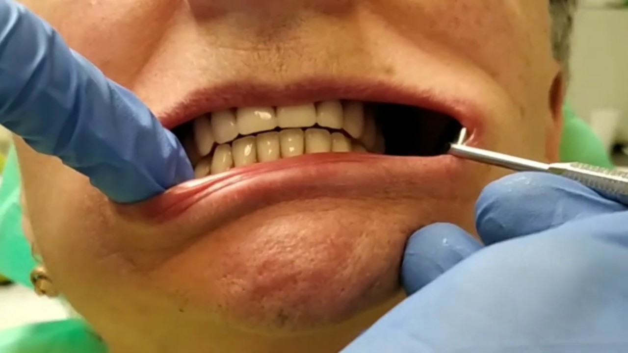 Alsó rögzített fogsor két implantátummal