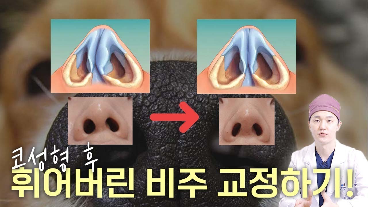 비중격연장술 후에 비주 휨, 콧구멍비대칭의 원인과 해결책 (feat. 성형외과 전문의)