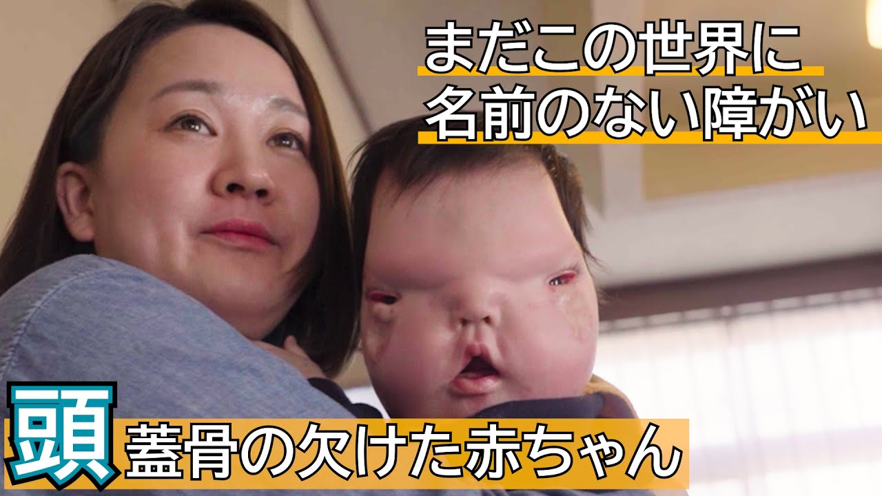 【顔面の形成異常】病名のつかない障がいを持つ赤ちゃんを育てる夫婦に密着supported by にしたんクリニック #にしたんクリニック #にしたん ARTクリニック　#共生社会  #障がい  #障害