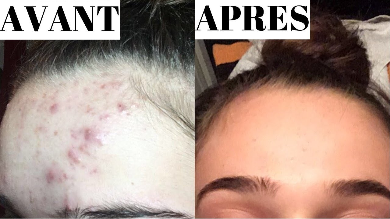COMMENT SE DEBARRASSER DE L'ACNE ET MA ROUTINE SOINS | Andie Ella