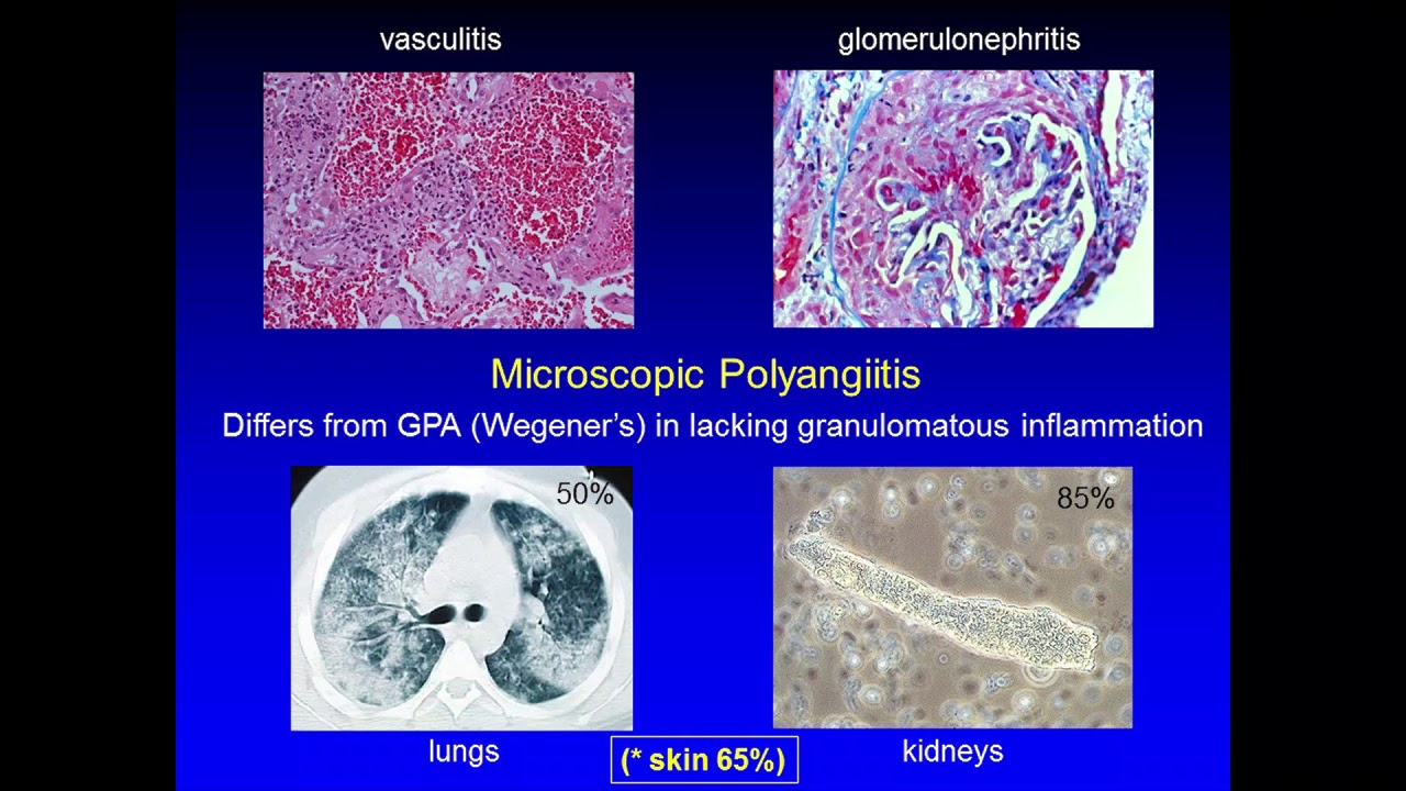 New and Emerging Treatments in Cutaneous Vasculitis