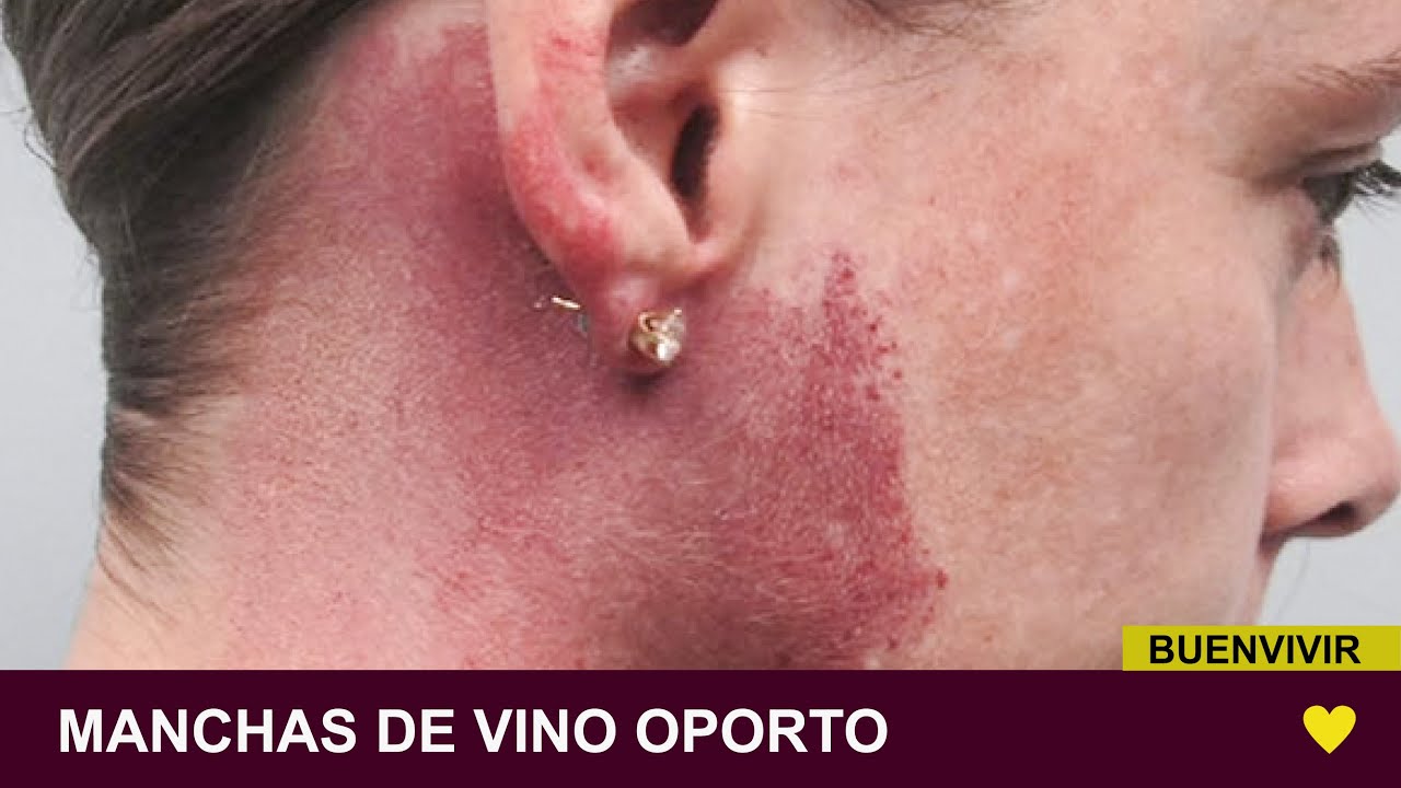 MANCHAS DE VINO OPORTO - MONTEVIDEO SKIN - BUENVIVIR💛 26/06/23 Canal 4
