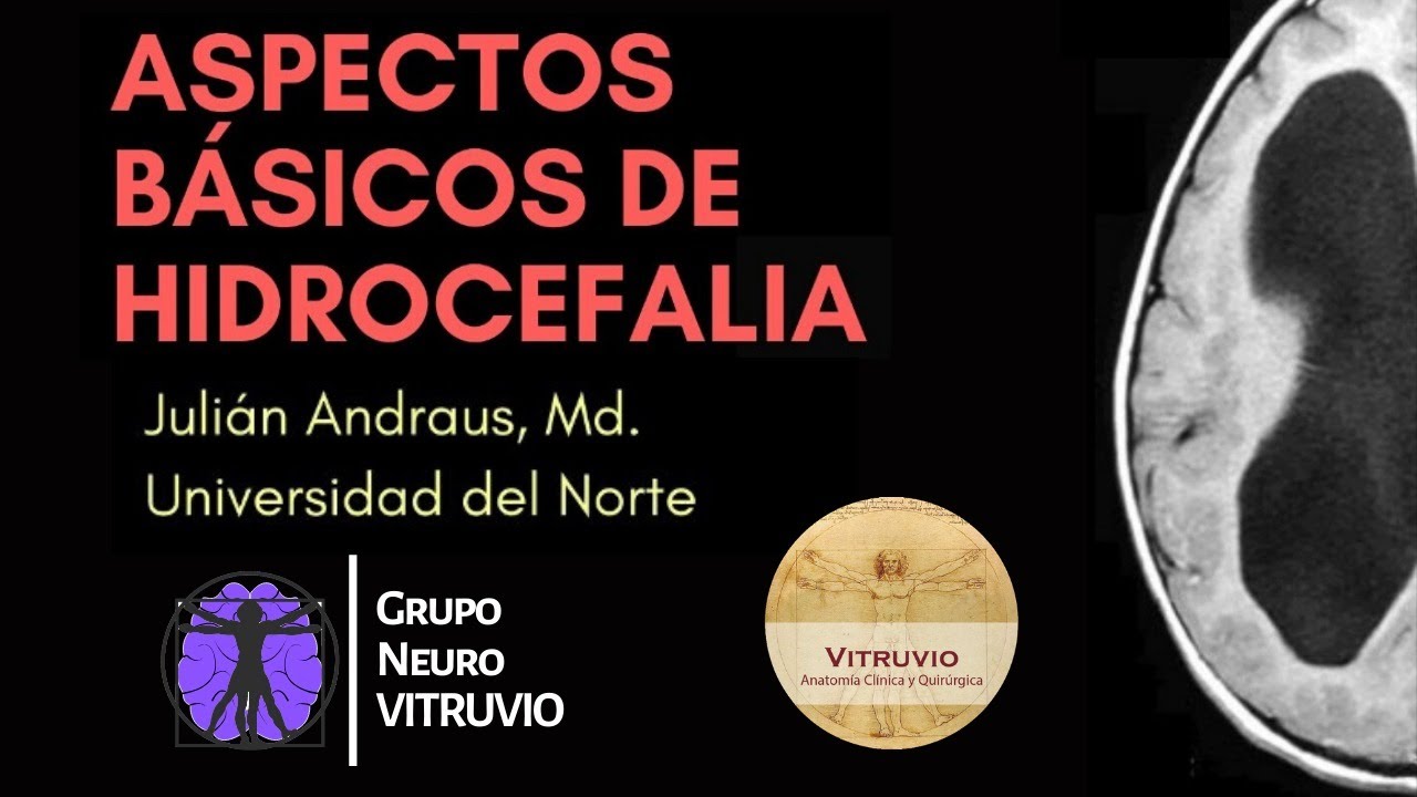 Aspectos básicos de hidrocefalia | Dr. Julián Andraus