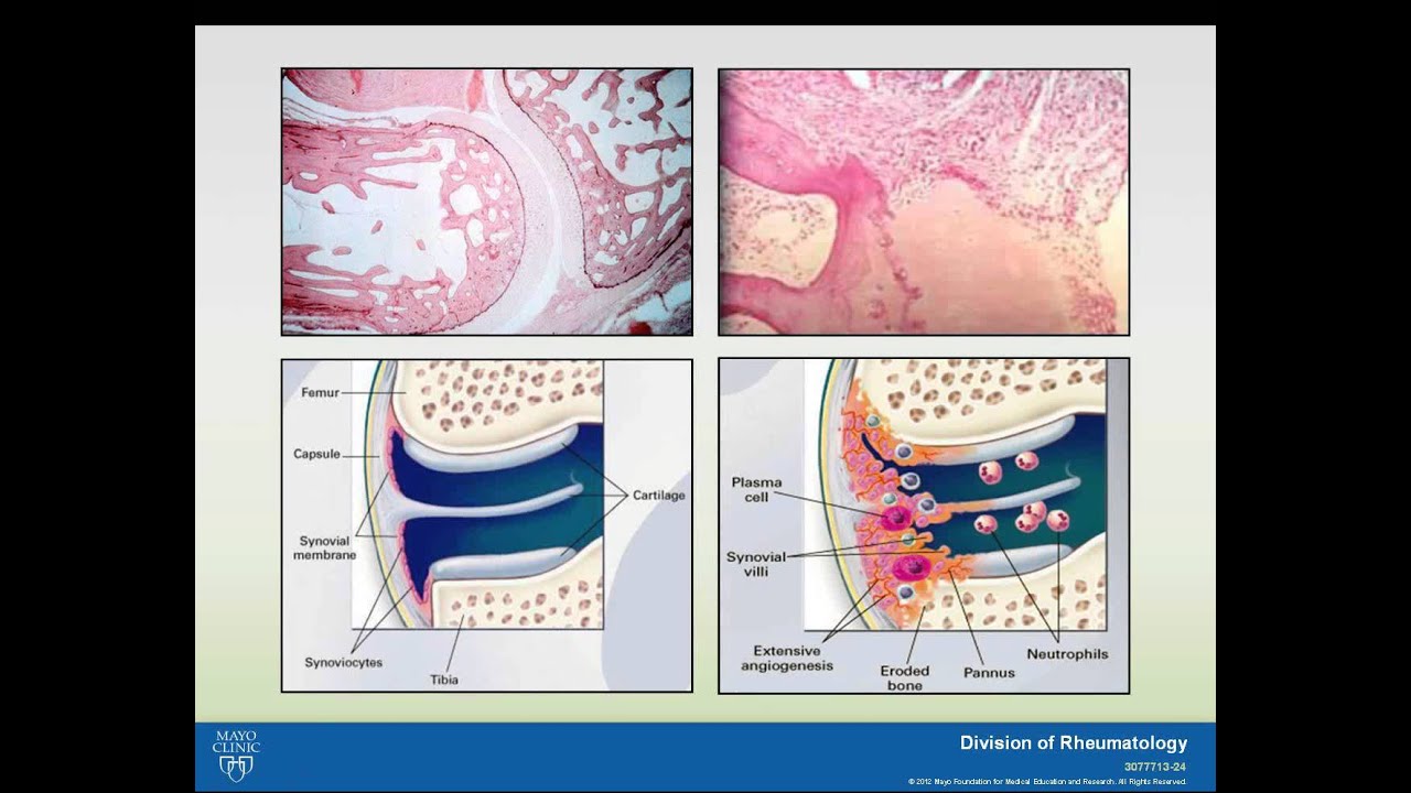 Rheumatoid Arthritis and Systemic Lupus Erythematosus Webinar