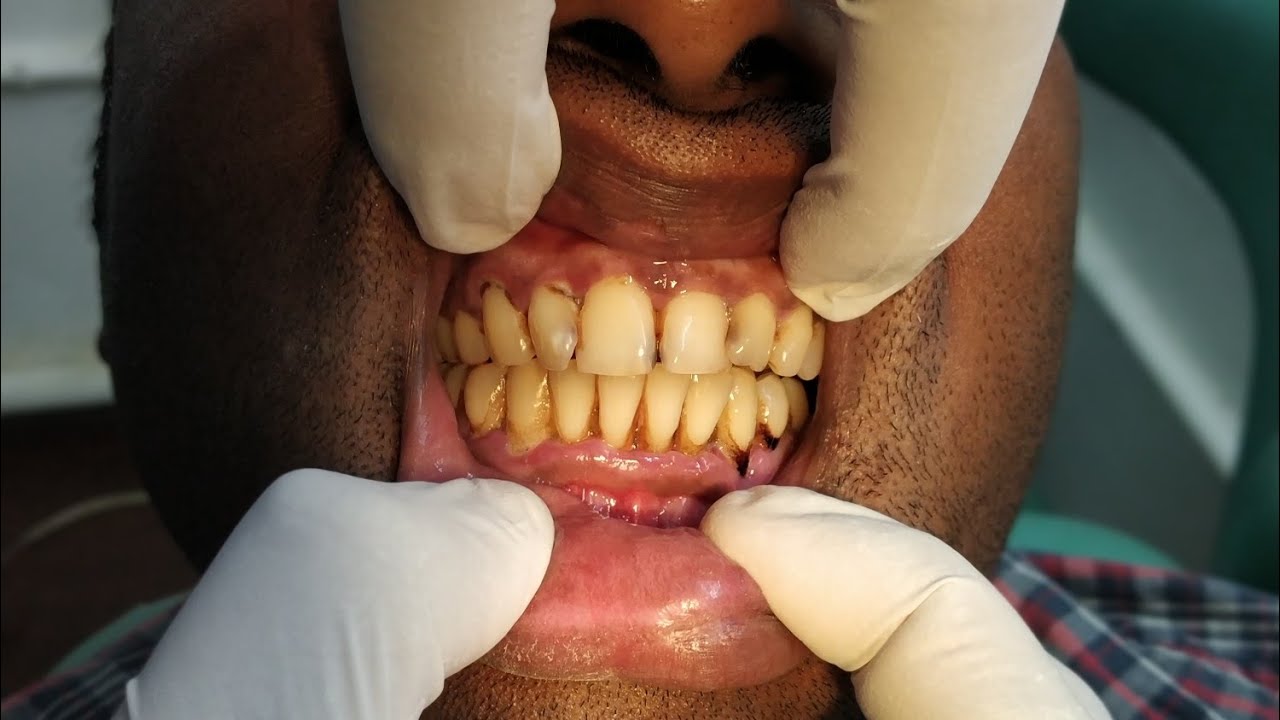OSMF - INITIAL SIGNS AND SYMPTOMS