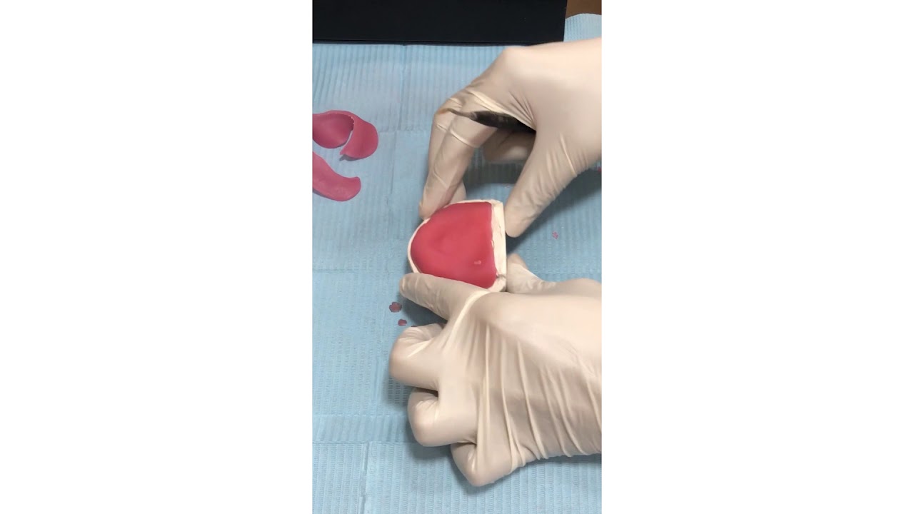 Custom impression tray with BLULUX light curing unit