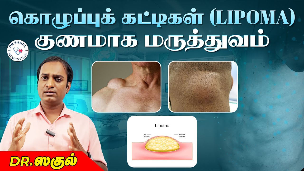 கொழுப்புக் கட்டிகள் (lipoma) குணமாக மருத்துவம் | #lipomatreatment | Dr Sagul R Mugunthan