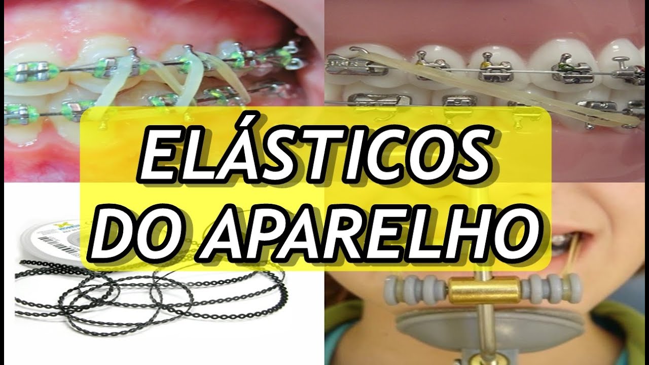 Tipos de ELÁSTICOS do Aparelho Ortodôntico | FUNÇÕES DE CADA UM DELES.