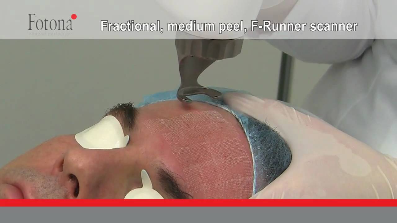 Medium peel with Fotona's fractional Er:YAG scanner F-Runner