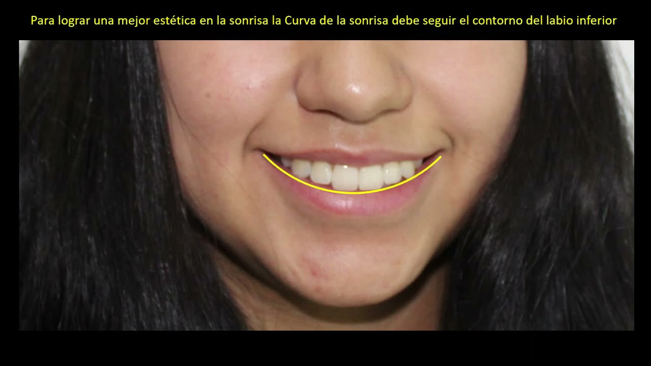 Smile Arc Protection. Ortodoncia.