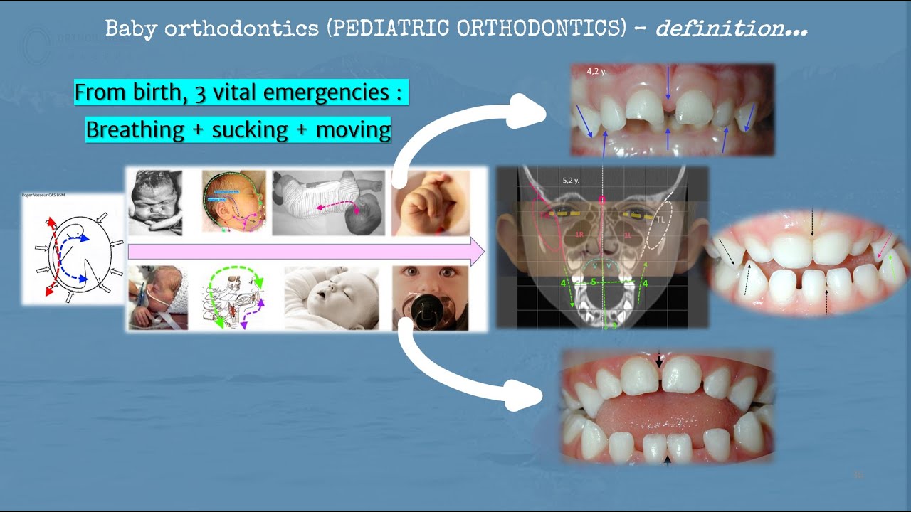 Vlog2-Engl-Pediatric Orthodontics (before 6 years age)