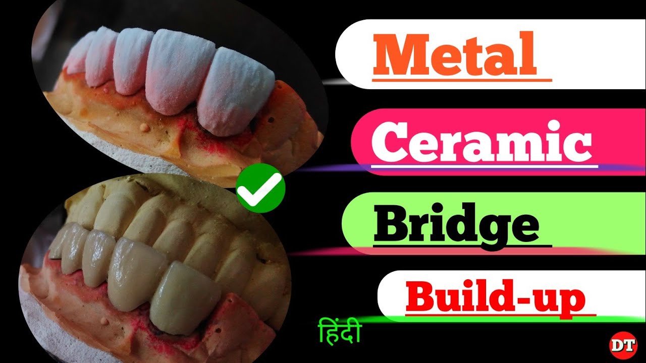 Metal Ceramic Bridge Build up| How to porcelain| Anatomy| Human Tooth| Dental Technician|Laboratory