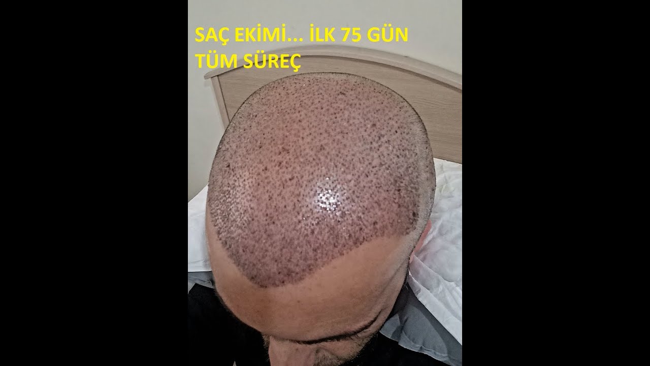 SAÇ EKİMİ İLK 75 GÜN SÜRECİ #sacekimi