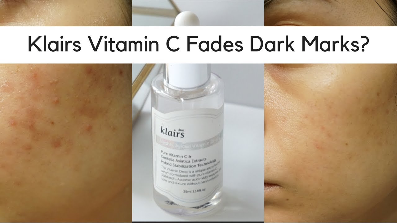 Klairs Freshly Juiced Vitamin C Review | Best Serum for Dark Marks?