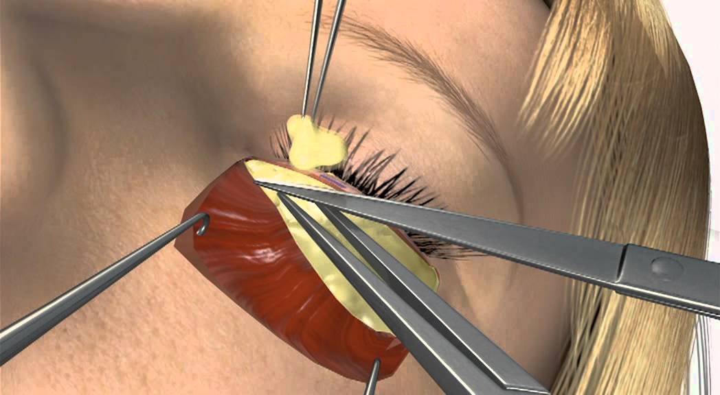 3-D animatie: Ooglidcorrectie onder