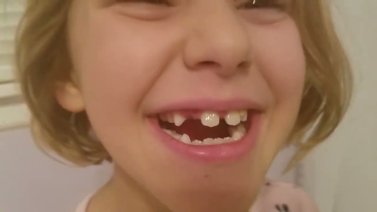 Losing a tooth
