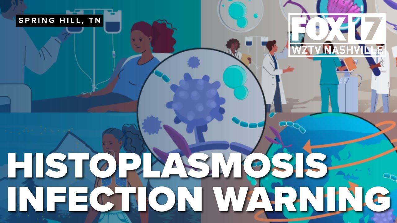 Tennessee warns of rising histoplasmosis, fungal cases in Williamson, Maury counties