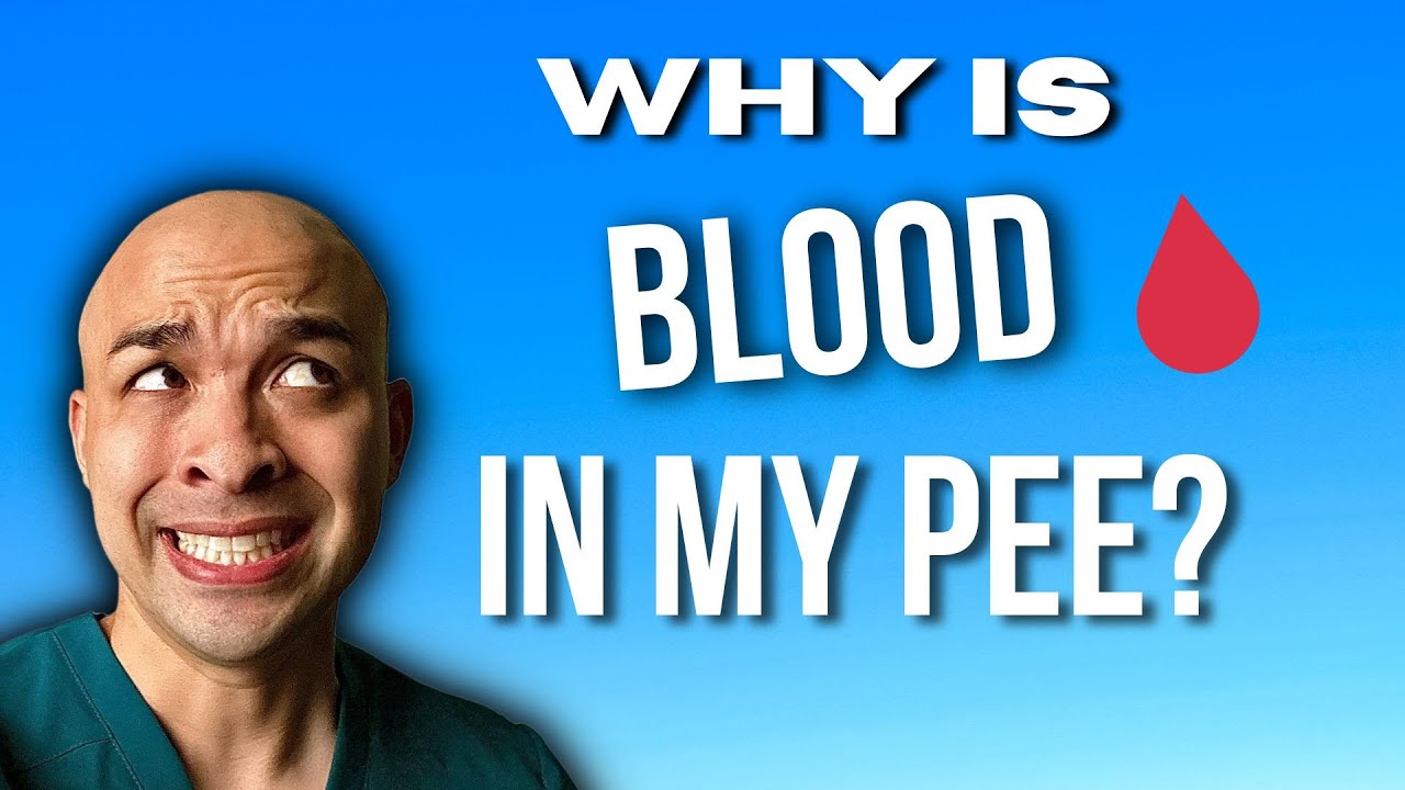 Why is there BLOOD in my pee?!? | Top 5 causes of Blood in Urine!