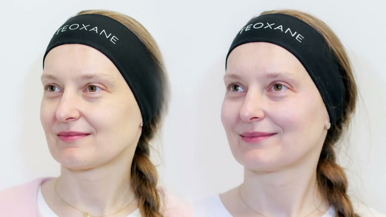 Wypełnienie doliny łez i redukcja cieni pod oczami