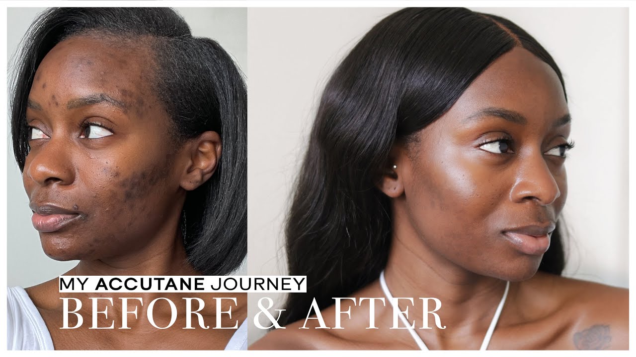 How I Cleared My Acne After 18 Years | Accutane Journey, Side Effects, Before & After