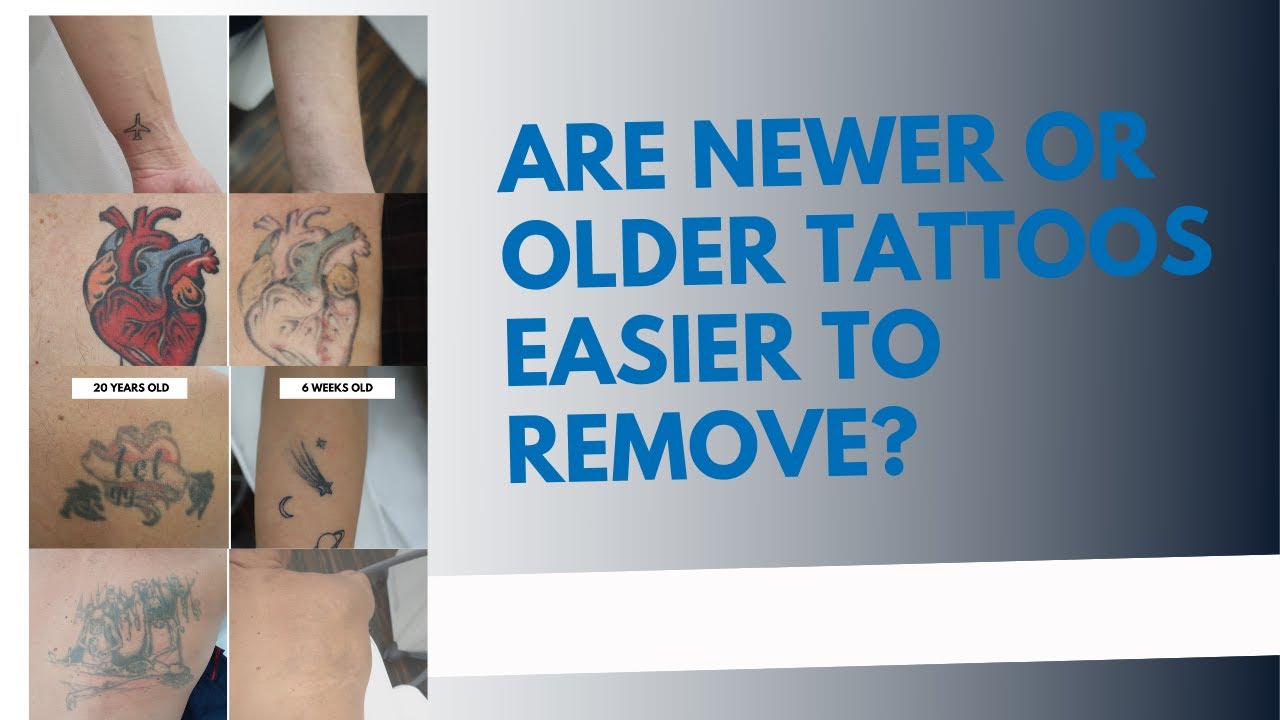 Are Newer Or Older Tattoos Easier To Remove?