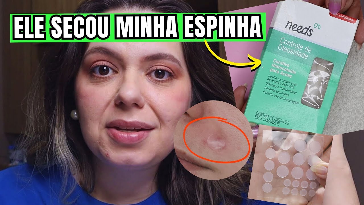 Testei CURATIVO HIDROCOLOIDE PARA ACNE nas minhas Espinhas (Marca Needs) | Resenha