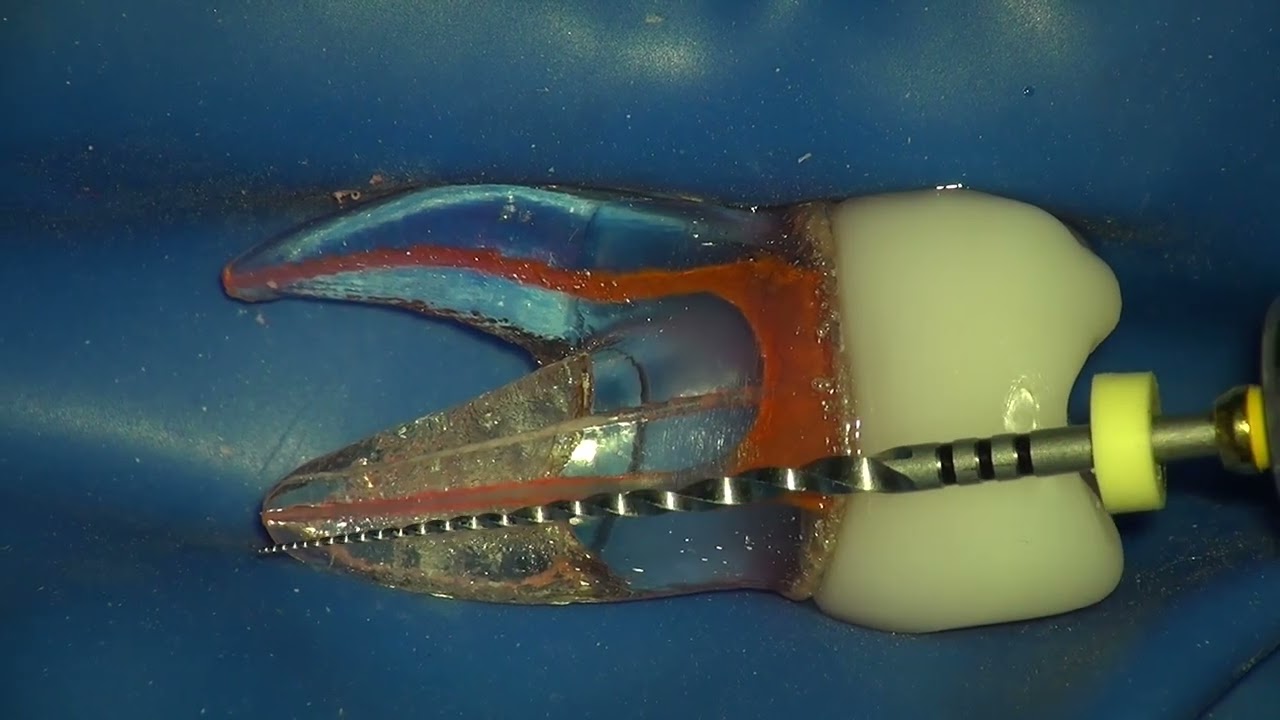 Dentsply Protaper NEXT Rotary File Easy Shaping Sequence