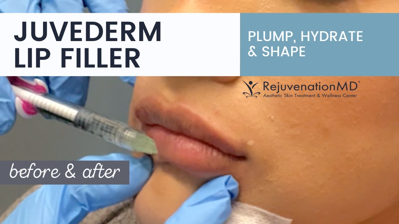 Dermal Lip Filler Enhancement in ONLY 5 Minutes! 💉