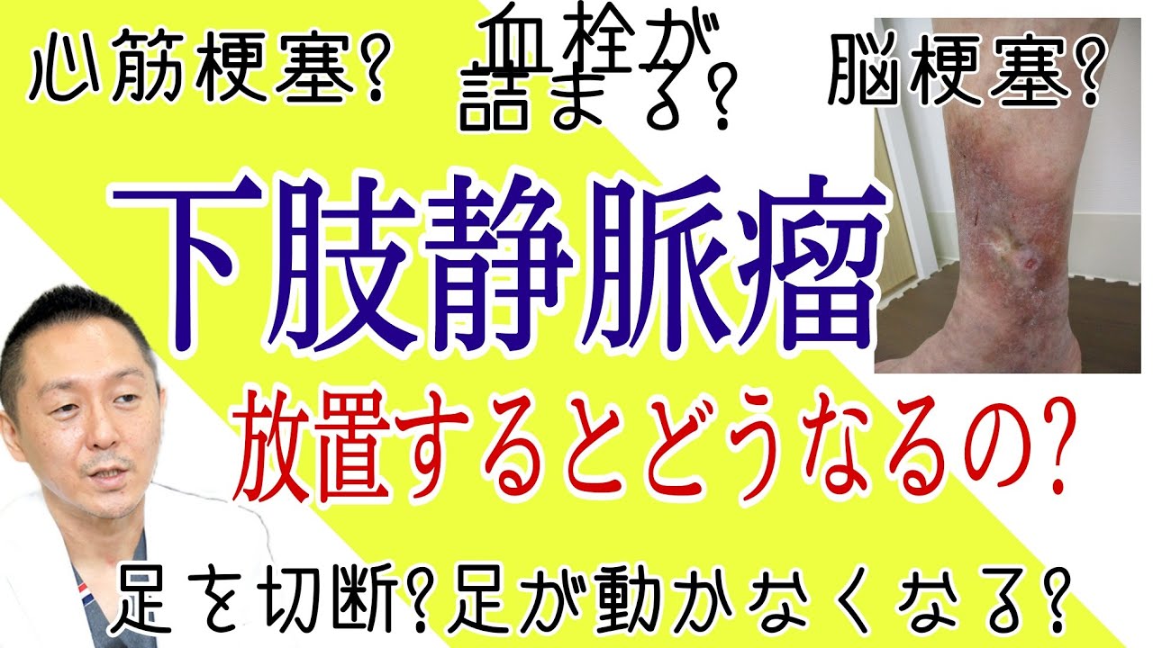 【下肢静脈瘤】放置するとどうなる？