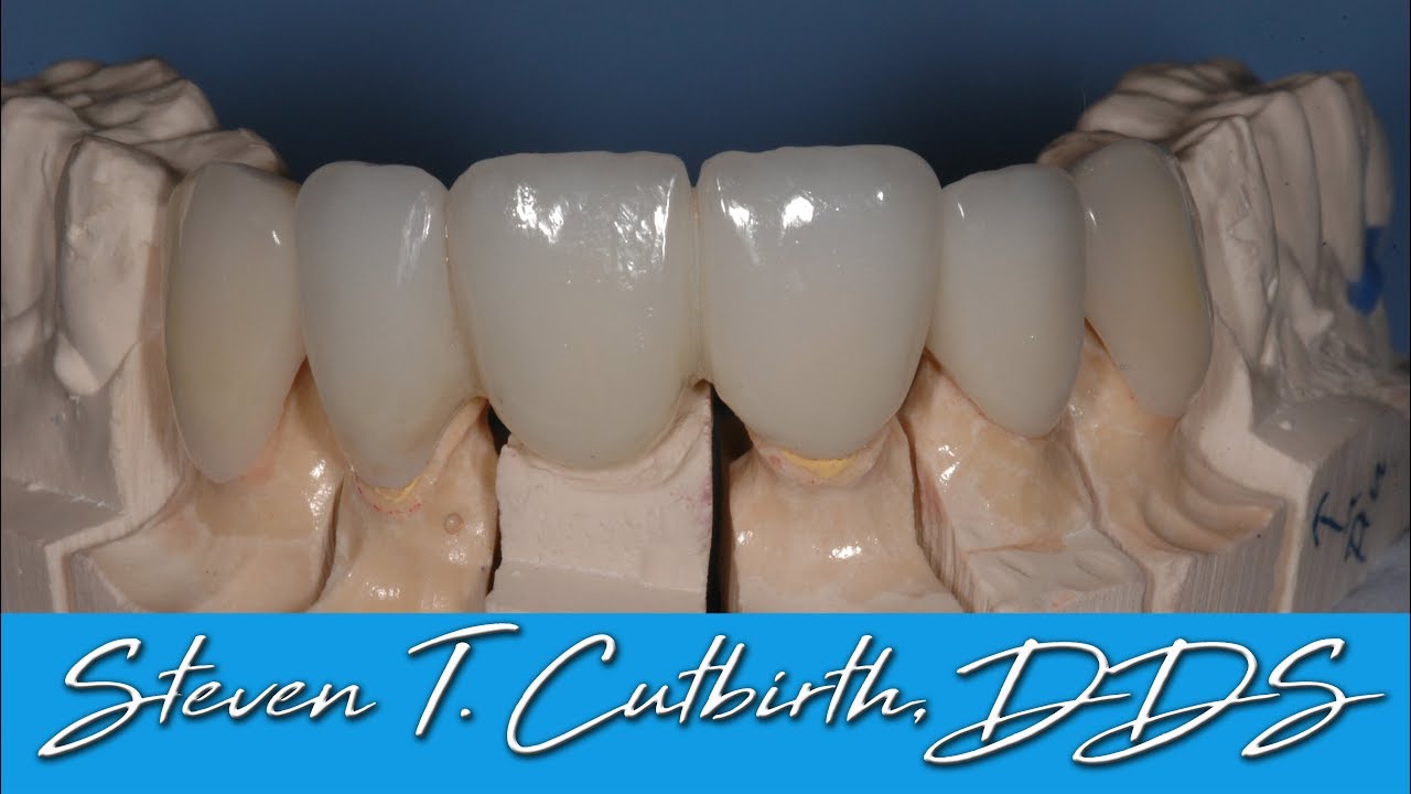 Seating Anterior Bridge and Crowns - Dental Minute with Steven T. Cutbirth, DDS