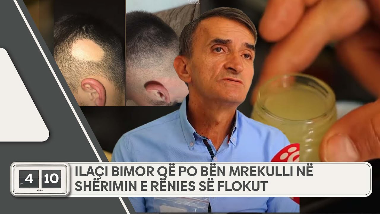 Ilaçi bimor që po bën mrekulli në shërimin e rënies së flokut