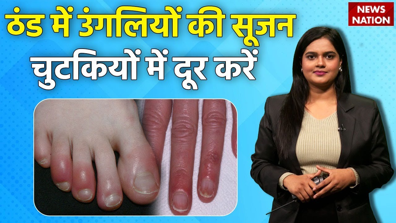 सर्दियों में क्यों सूज जाती हैं हाथ-पैर की उंगलियां? Swelling in winters | Healthy Nation | EP38