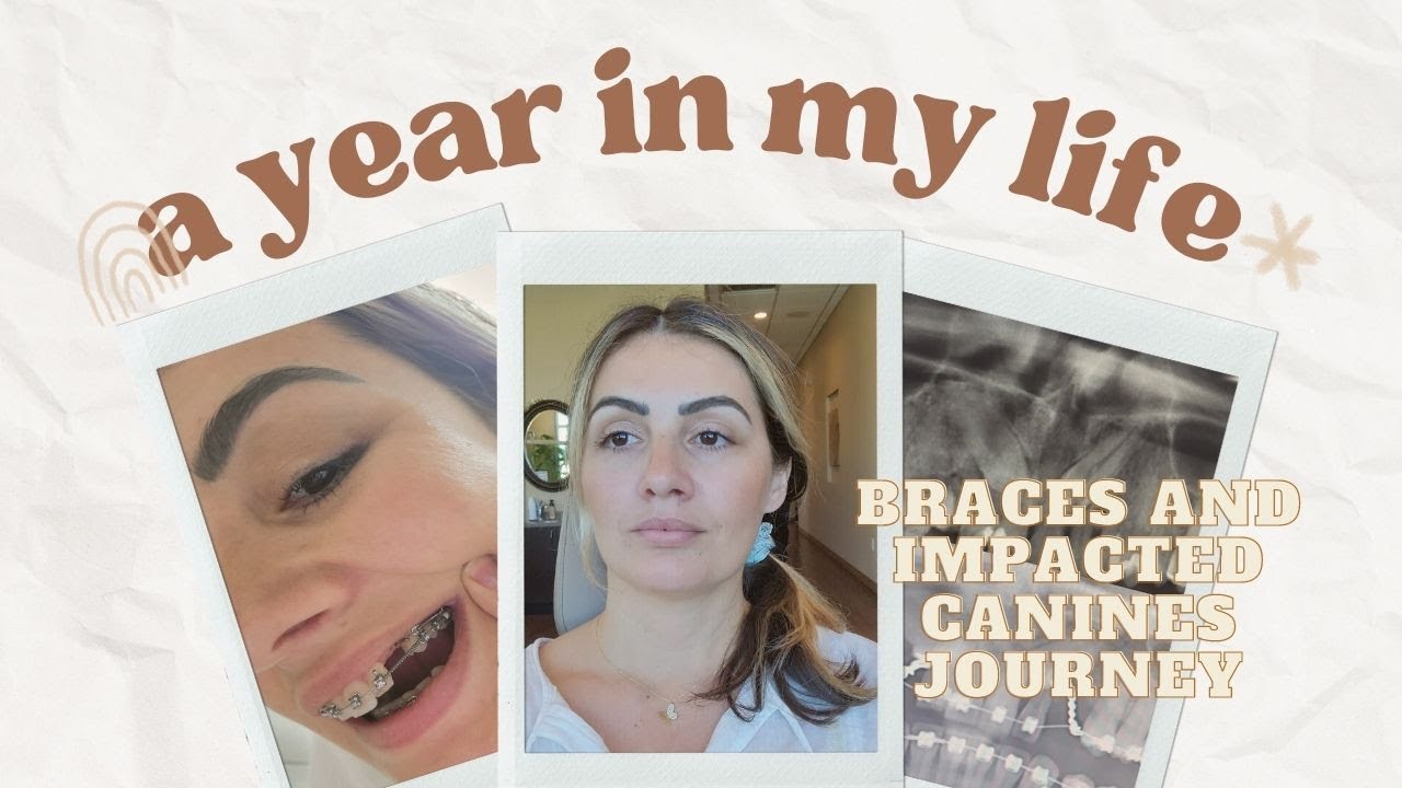 1 YEAR WITH BRACES | Impacted Canine Journey- Have my teeth moved?