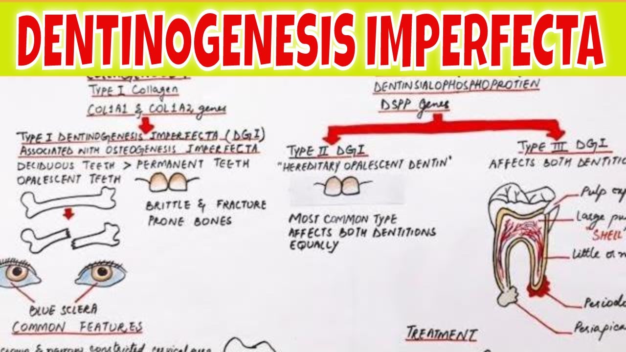 Dentinogenesis Imperfecta - Pathogenesis, Types, Clinical features and Treatment